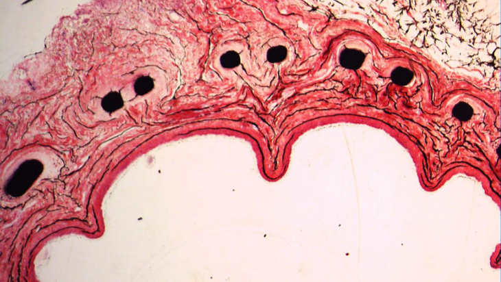 Exostent aus Nitinol
